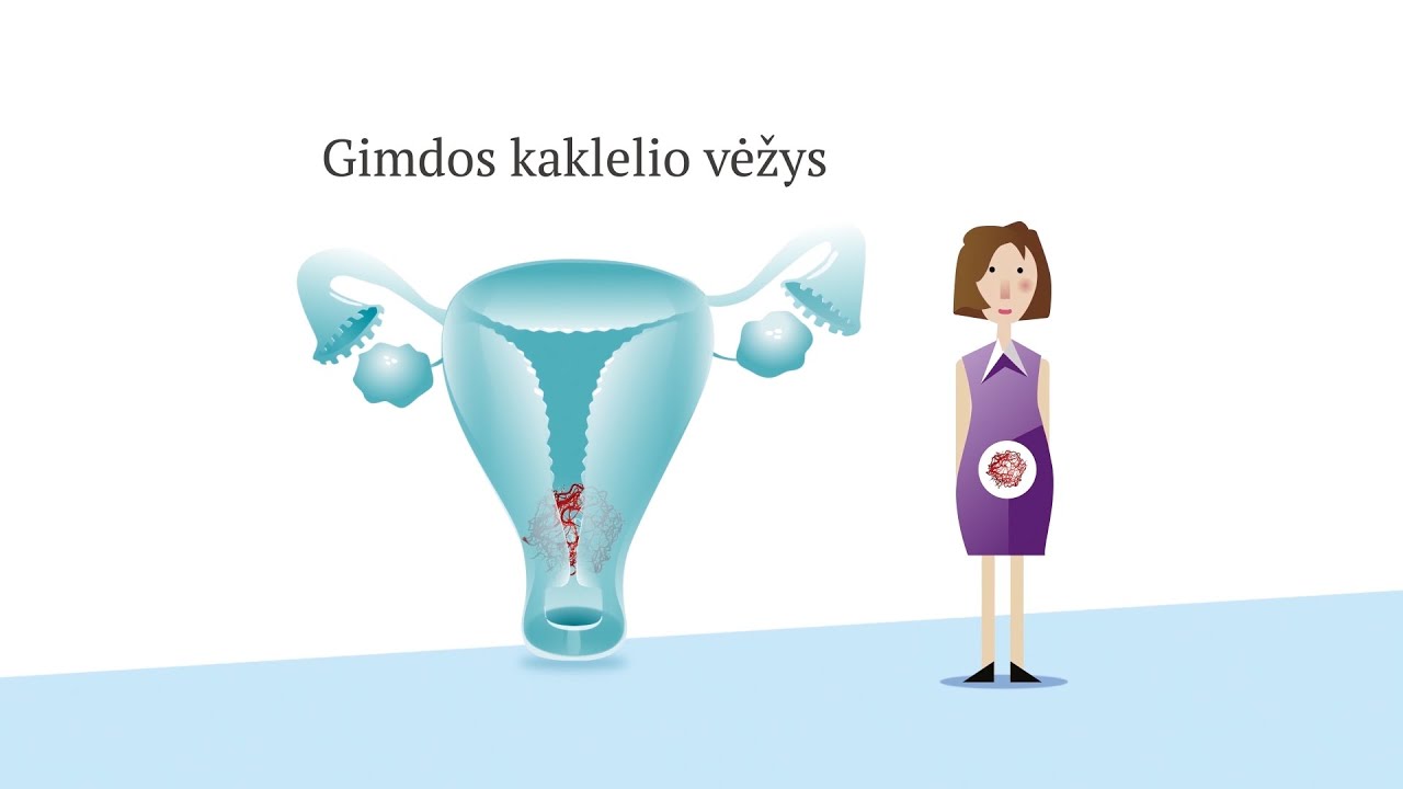 Gimdos kaklelio vėžys