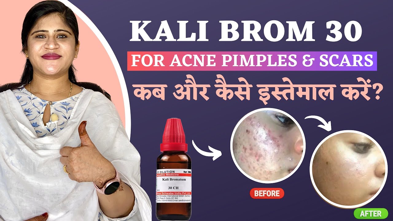 Magical Remedy For Acne Pimples and Scars | kali Brom 30 | कब और कैसे इस्तेमाल करें ? Dr. Arwa Bohra