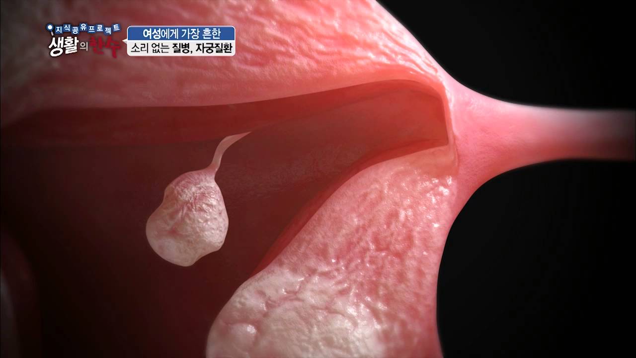 여성의 흔한 질병, 자궁질환. 그 종류는 어떤것들이 있을까? [생활의 한수]