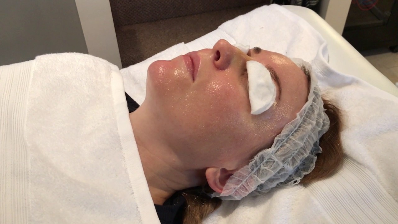 EnerPeel Mandelic Acid Combined with Microneedling