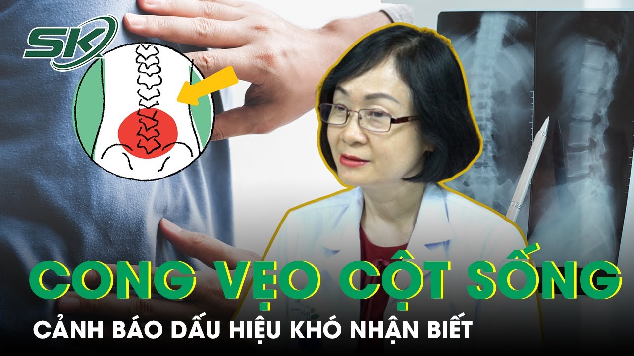 Cảnh báo những dấu hiệu cong vẹo cột sống ở trẻ cần phát hiện sớm | SKĐS