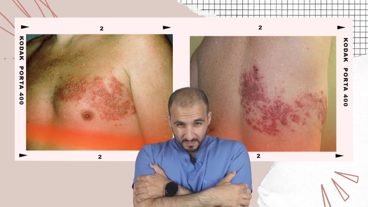 الحزام الناري 😨 (الأعراض والوقاية والعلاج)