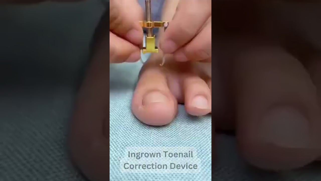 Best Ingrown Toenail Correction Device || #shorts