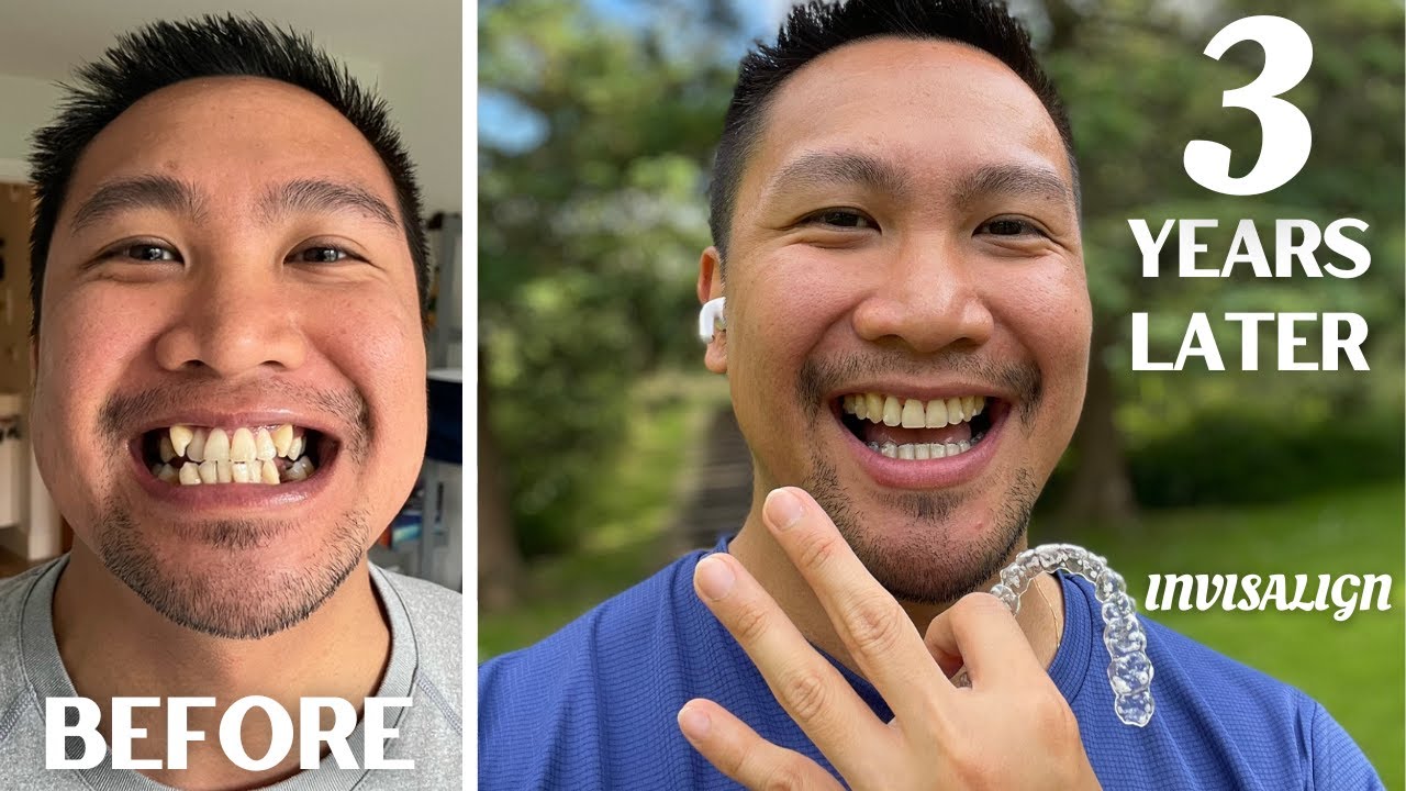 3 YEAR TEETH JOURNEY UPDATE | MONTH 38 UPDATE | Invisalign Journal