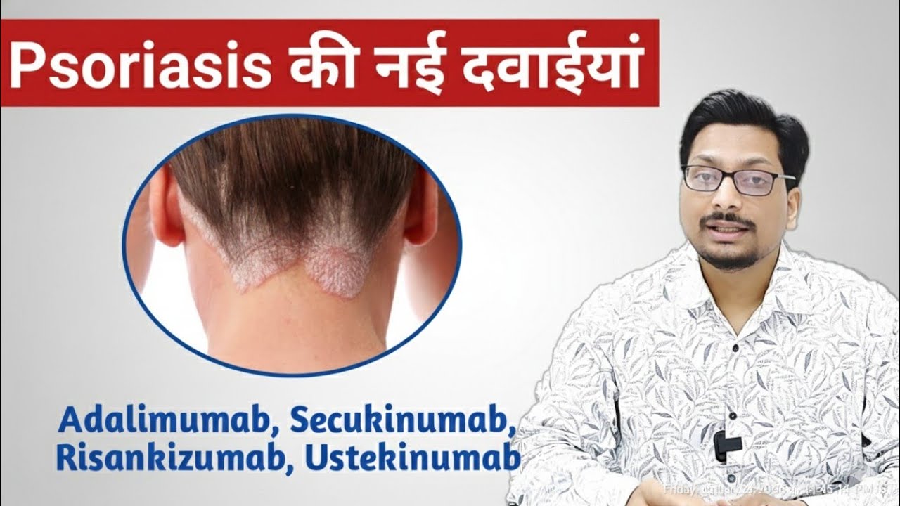 Psoriasis की नई दवाइयाँ | Newer Medicines of Psoriasis, Adalimumab, Secukinumab, Risankizumab Scapho