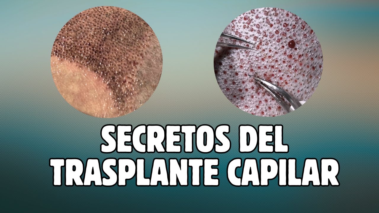 CIRUJANA CAPILAR CUENTA SECRETOS SOBRE C&Oacute;MO ES UN TRASPLANTE Y C&Oacute;MO TENER UN BUEN RESULTADO