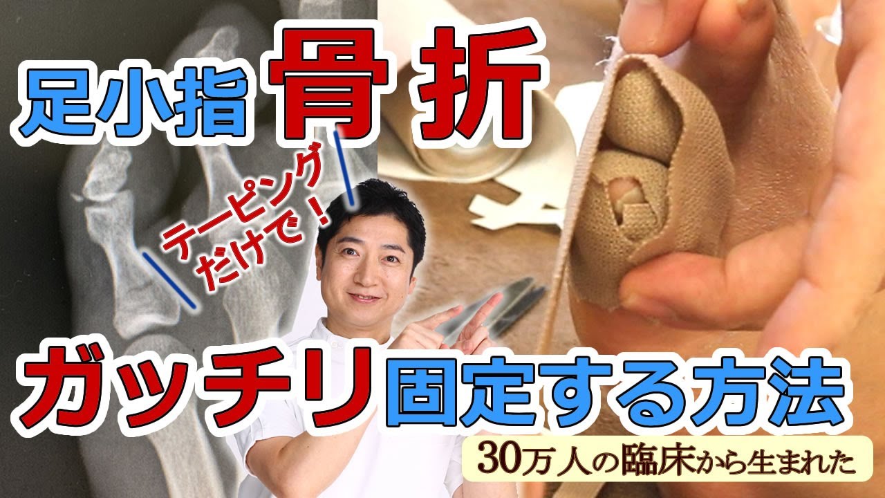 【実録】足の小指の骨折。テーピングだけで安全に固定する方法と、注意点を実際おケガした方の足をお借りしてわかりやすく実演します。