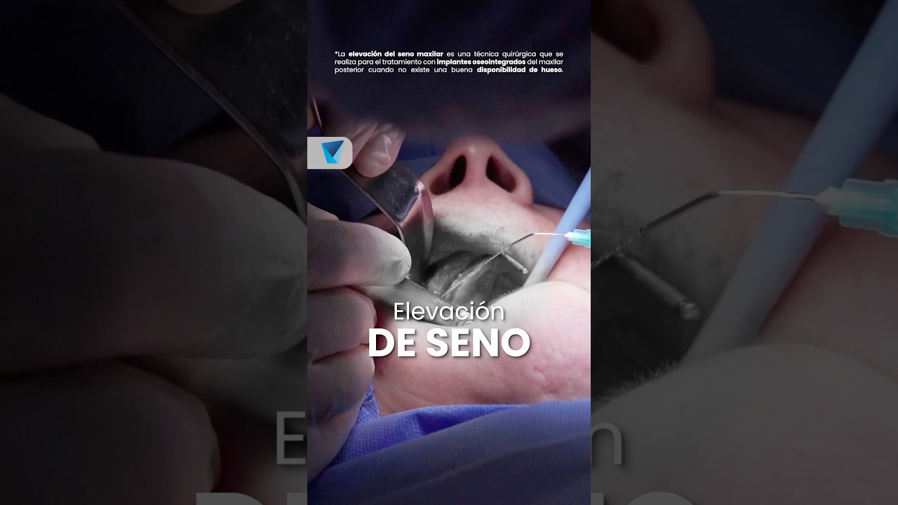 &iexcl;La falta de hueso NO es un impedimento para sonre&iacute;r! 😃✨ #dentistasdeconfianza #dentistasporchile