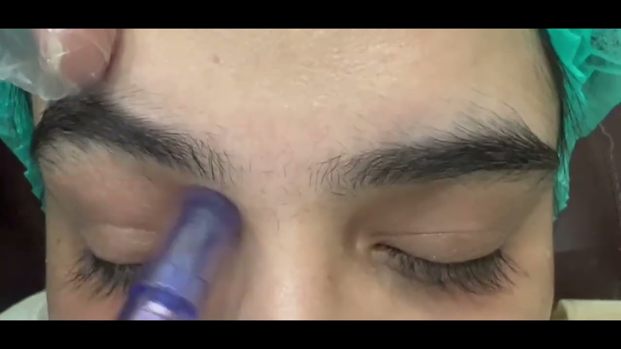 Dark Circles Treatment #skin #darkcircles #Maestheticsclinic