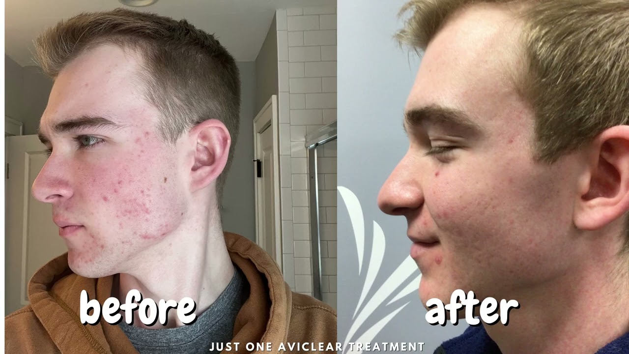 Zach's AviClear Story