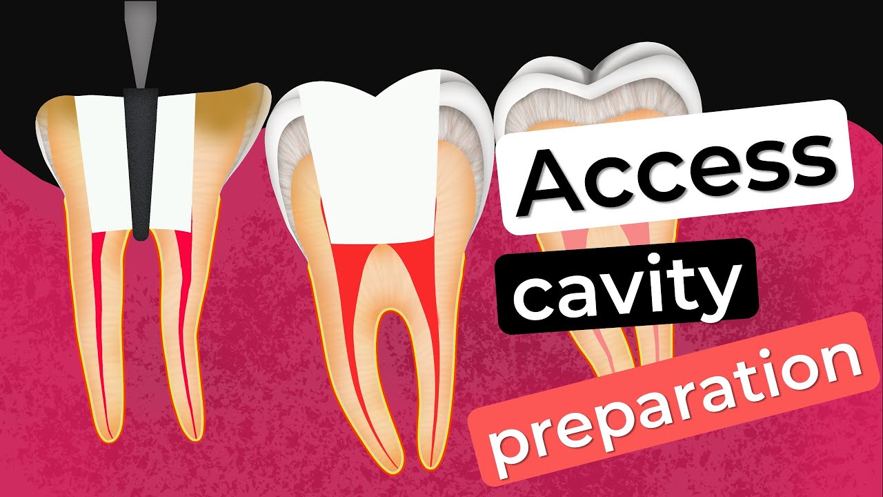 Access cavity preparation : How to prevent errors