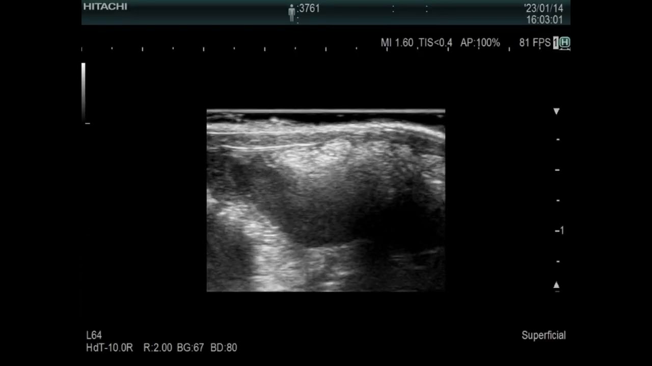 Echo image of  Pyometra in a djungarian hamster （ジャンガリアンハムスターの子宮蓄膿症のエコー）