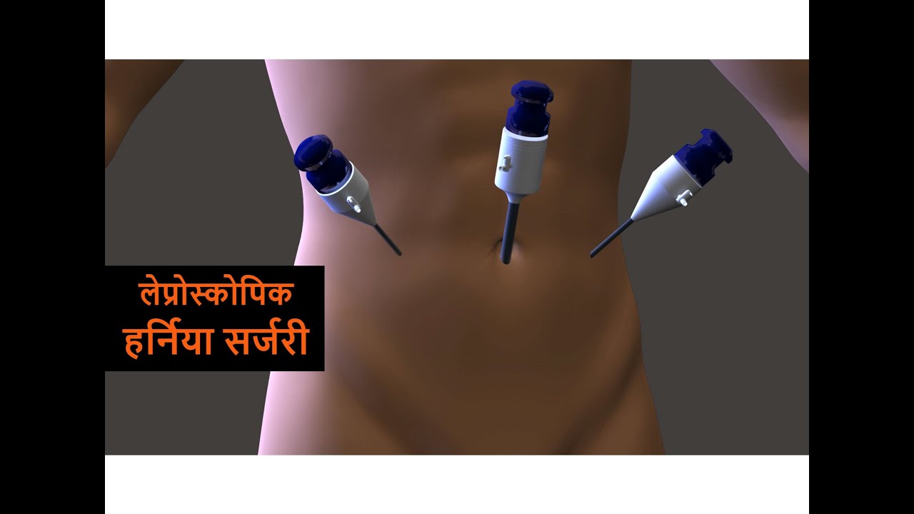 लेप्रोस्कोपिक  इनगुइनल हर्निया सर्जरी की संपूर्ण जानकारी  Best Laparoscopic Inguinal Hernia In India