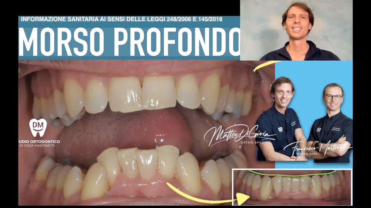 Come Correggere il Morso Profondo e i Denti Storti con Allineatori Trasparenti | Ortodonzia Adulti