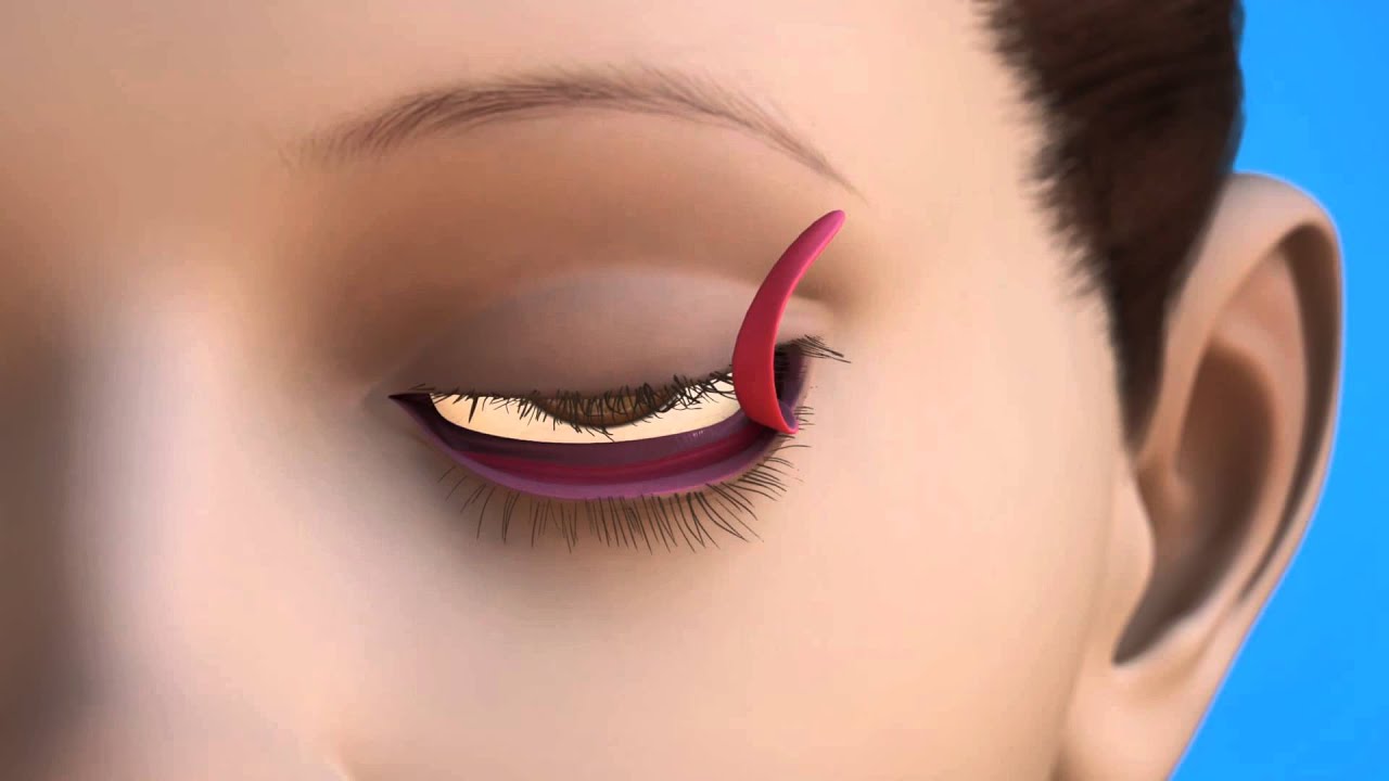 Repairing eyelid position: Oculoplastics Entropion Ectropion Repair