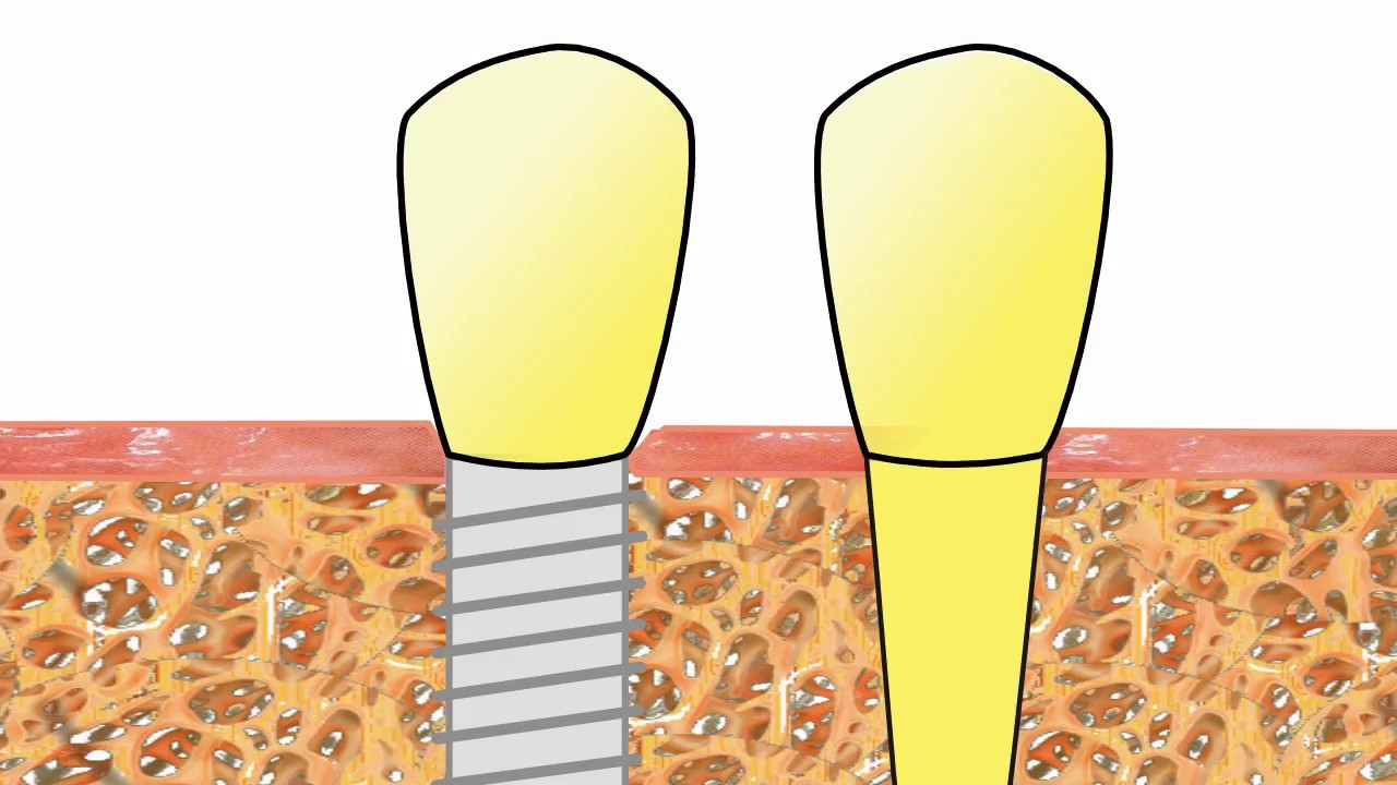 Die Entzündung am Implantat: Ursache und Behandlung