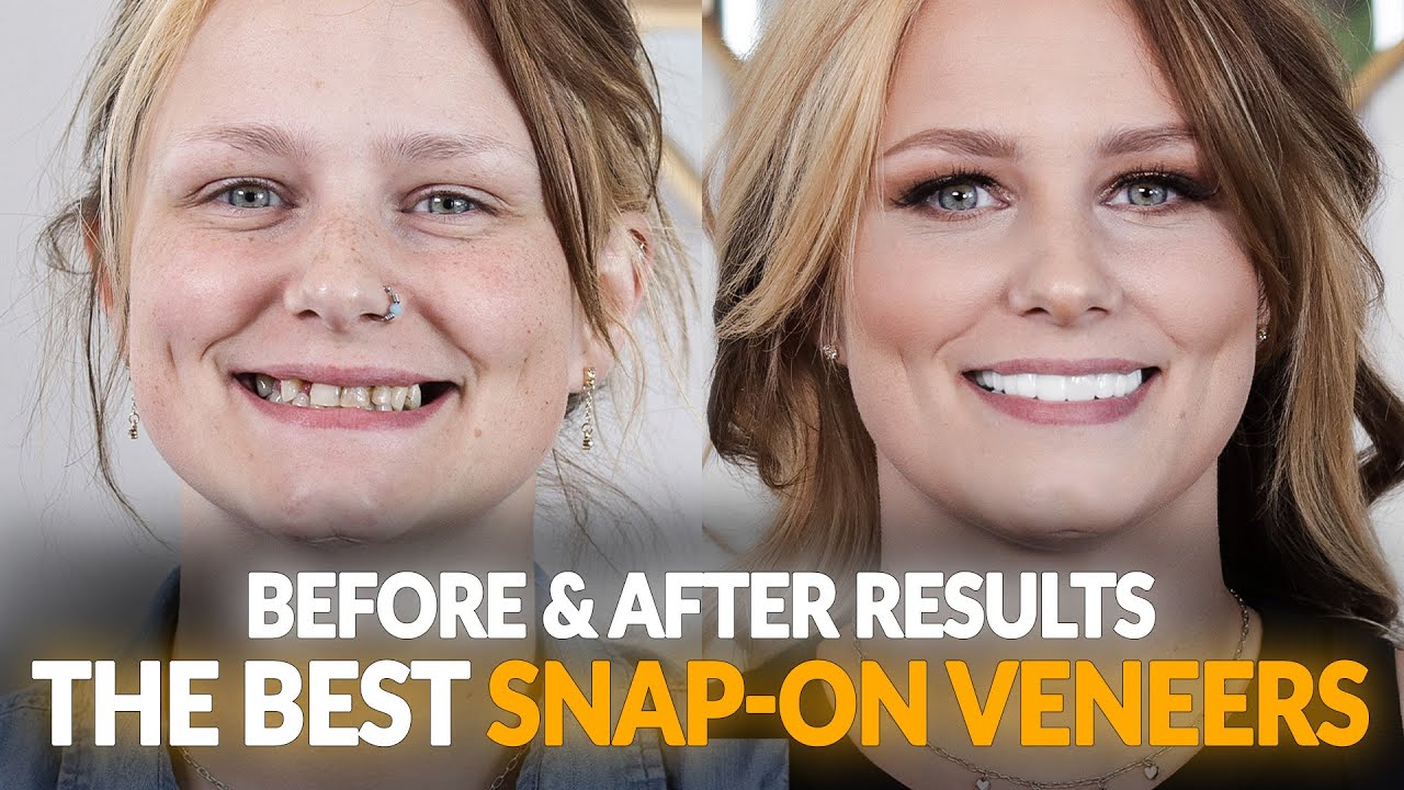 Transforming Smile Makeovers w/ Snap On Dental Veneers: Why Before & After Photos Matter