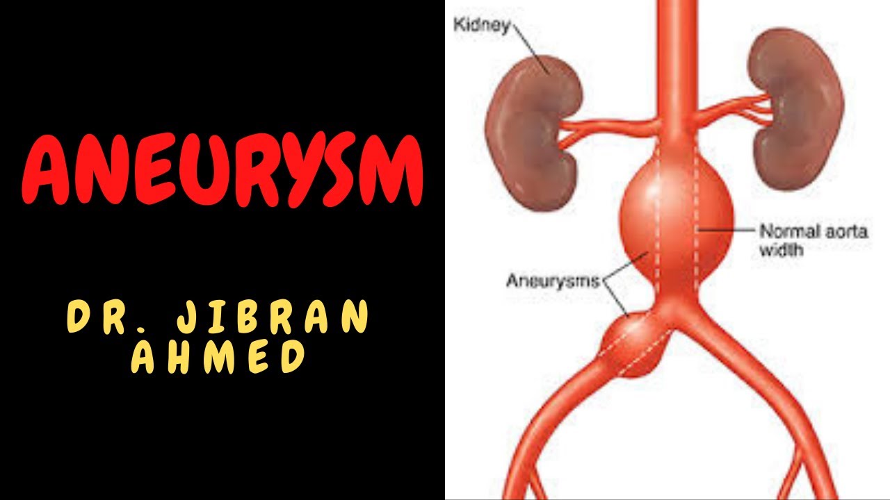 ANEURYSM II BLOOD VESSELS II SYSTEMIC PATHOLOGY II ROBBINS 10TH E II PATHOLOGY LECTURE