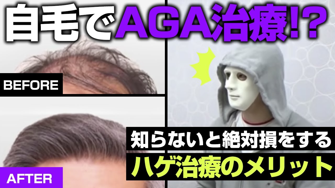 【薄毛治療】ラファエルさんも絶賛の自毛植毛とは！？植毛手術・AGA治療を徹底解説【湘南美容クリニック】