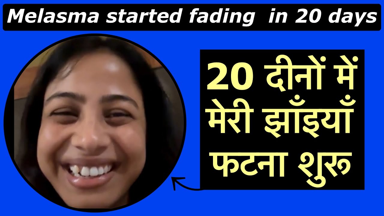 20 दीनों में मेरी झाँइयाँ फटना शुरू 😍 My Melasma started fading in 20 days
