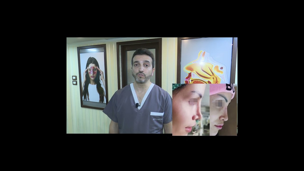 عملية اعادة ترميم الأنف بعد عملية سابقة