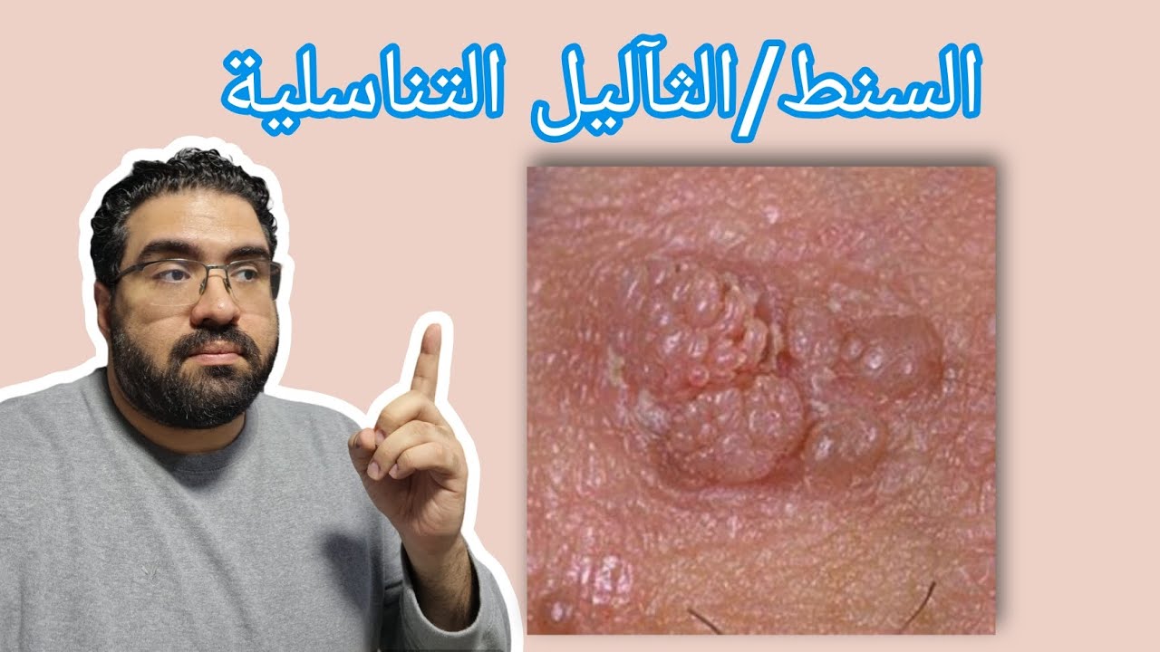 عيادة الجلدية - حلقة ٨ - السنط/الثآليل التناسلية(genital warts)