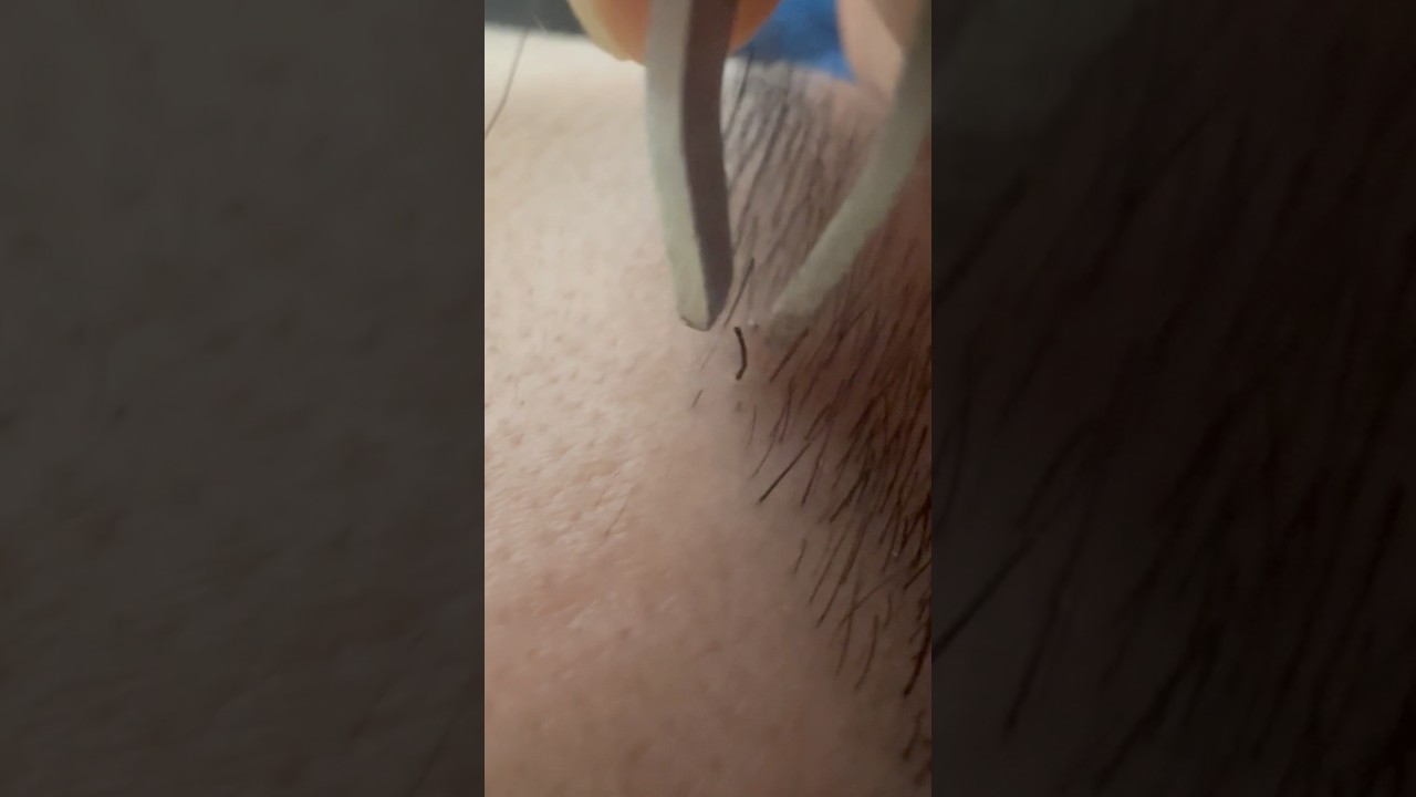 Goodbye, Thick Eyebrow Hair!#hairremoval #plucking #tweezers