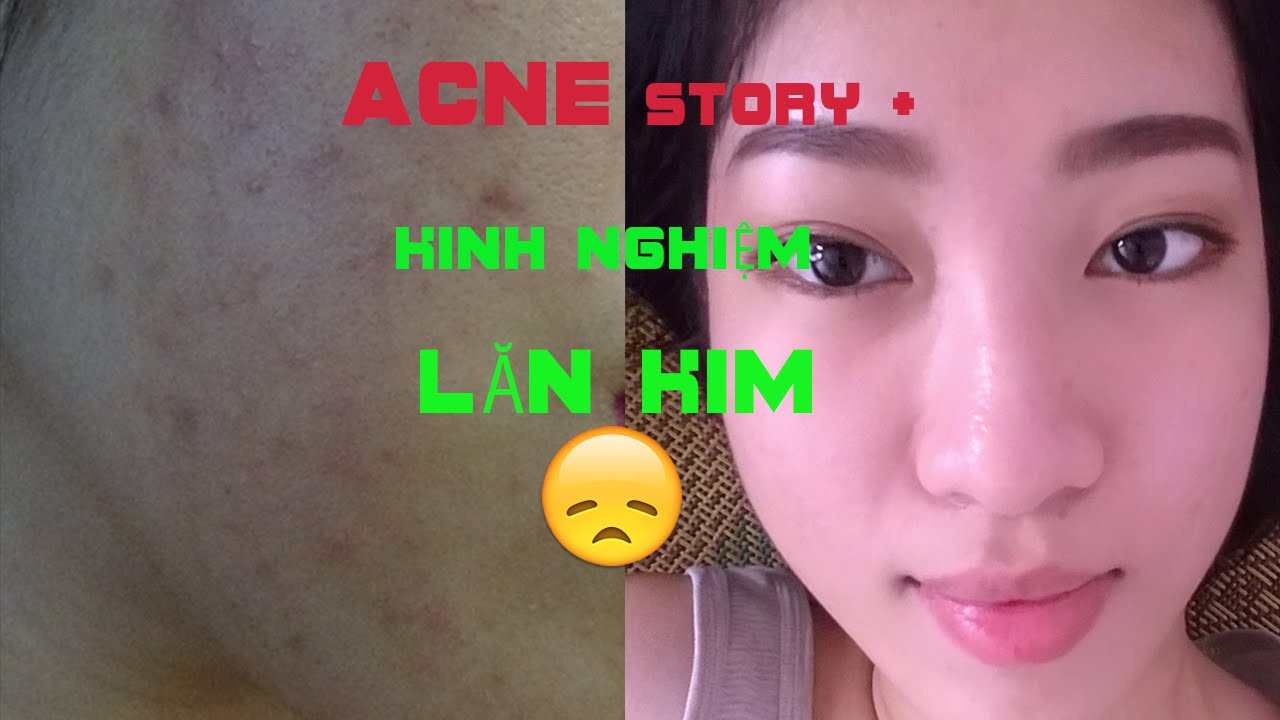 #Chia Sẻ: Câu Chuyện Trị Mụn & Cách Trị Mụn Bằng Lăn Kim - My Acne Story [ VANMIU BEAUTY ]