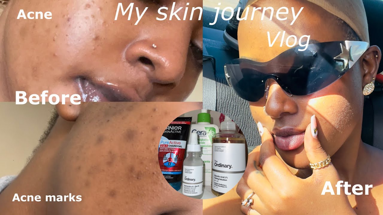 SKIN CARE ROUTINE TO REMOVE ACNE (AM&PM)/Products I used to remove Acne and Dark marks/ The ordinary