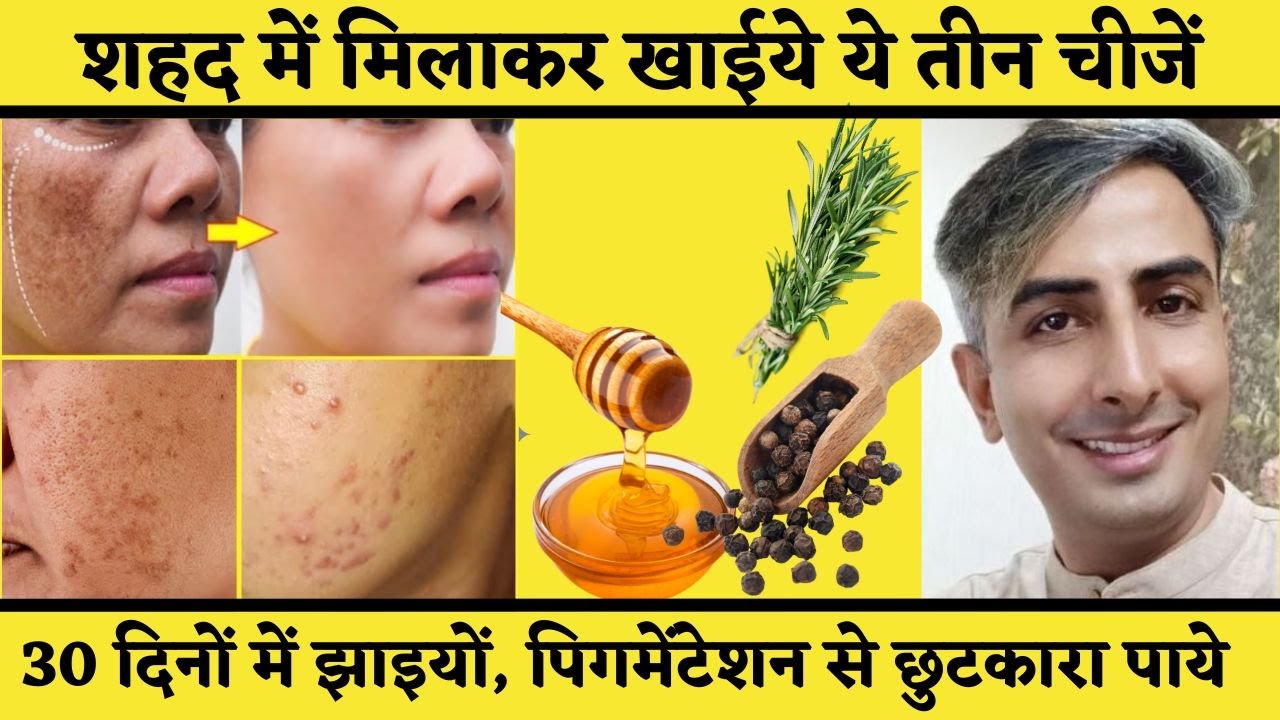 In 30 Days Remove Dark Patches I Pigmentation I Dark Spots  Naturally | 100% Results I DR. MANOJ DAS
