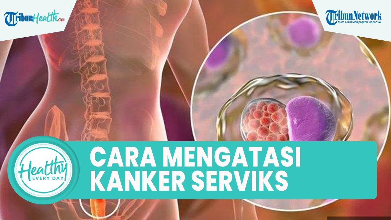 Cara Mengatasi Kanker Serviks dengan Metode dr. Ibnu Sina