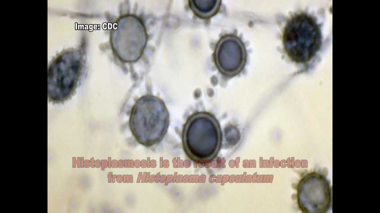 Histoplasma capsulatum & Histoplasmosis