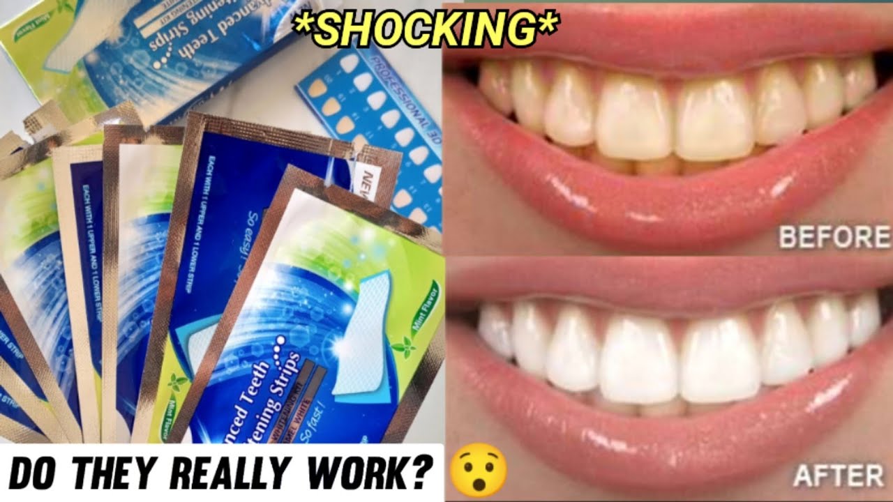 *INSANE* Urgent Teeth Whitening Strips | Teeth whitening at home