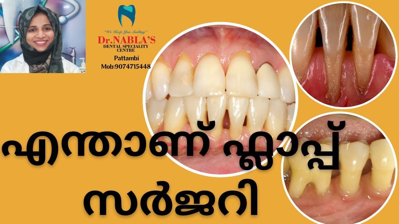 #മോണ ഇറങ്ങാറുണ്ടോ?#എന്താണ് ഫ്ലാപ് സർജറി#മോണ ഇറക്കം എങ്ങനെ ശരിയാക്കാം#എന്തുകൊണ്ടാണ് മോണ ഇറങ്ങുന്നത്