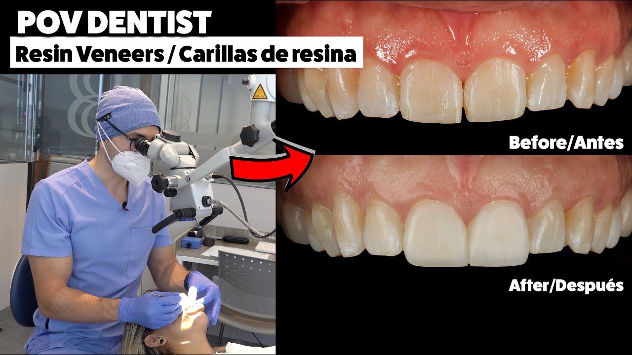 Resina Inyectada, visto desde un microscopio dental. ¡Toda una experiencia POV!