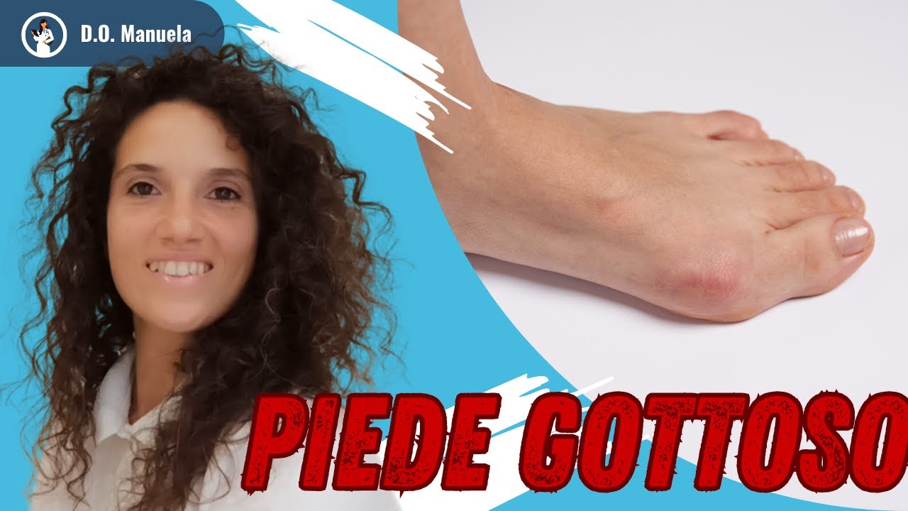 🔥GOTTA NEL PIEDE: cos'è e come affrontarla
