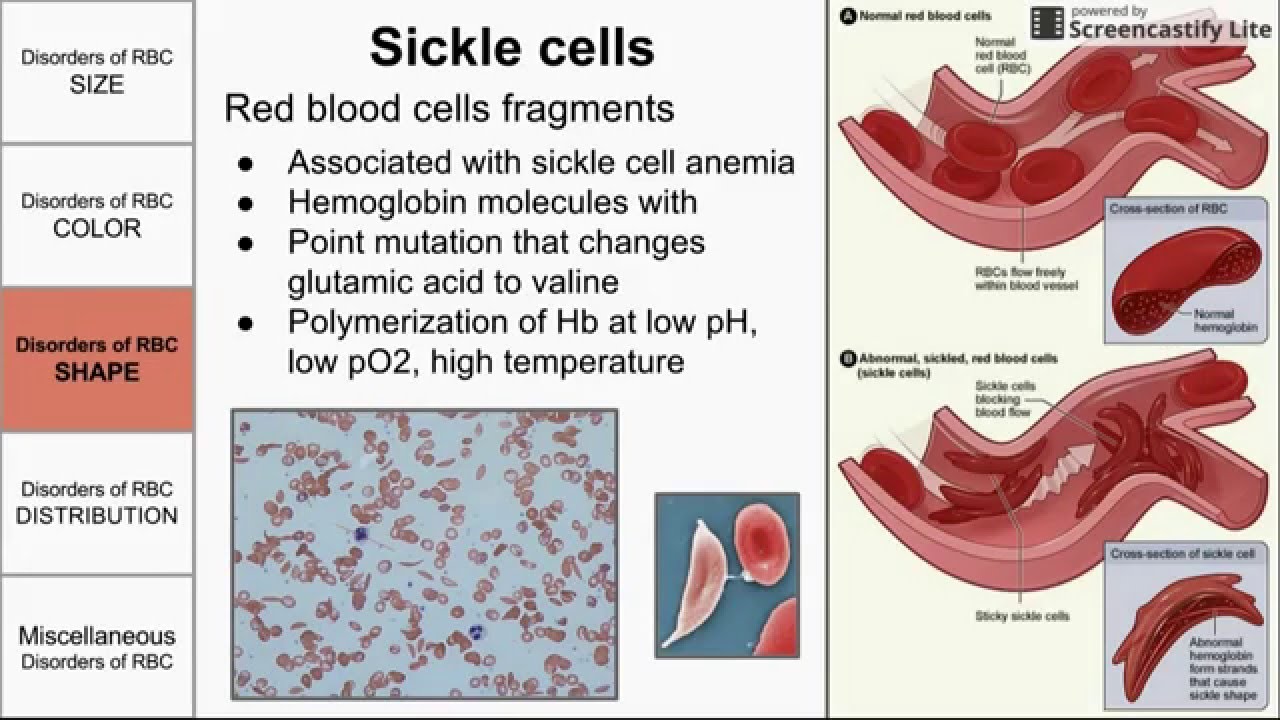 Red Blood Cell Morphological Abnormalities