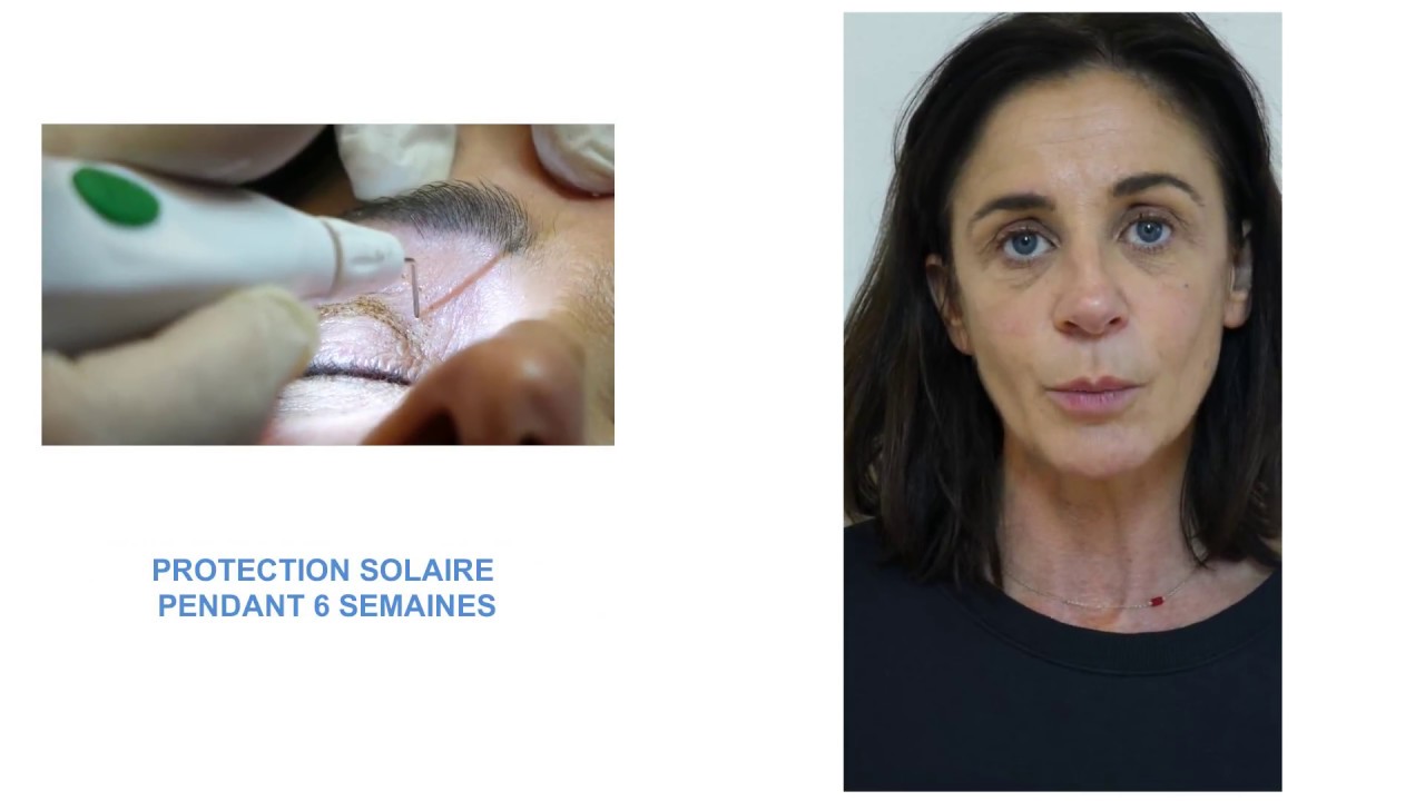 Témoignage patient Plexr : traitement des paupières