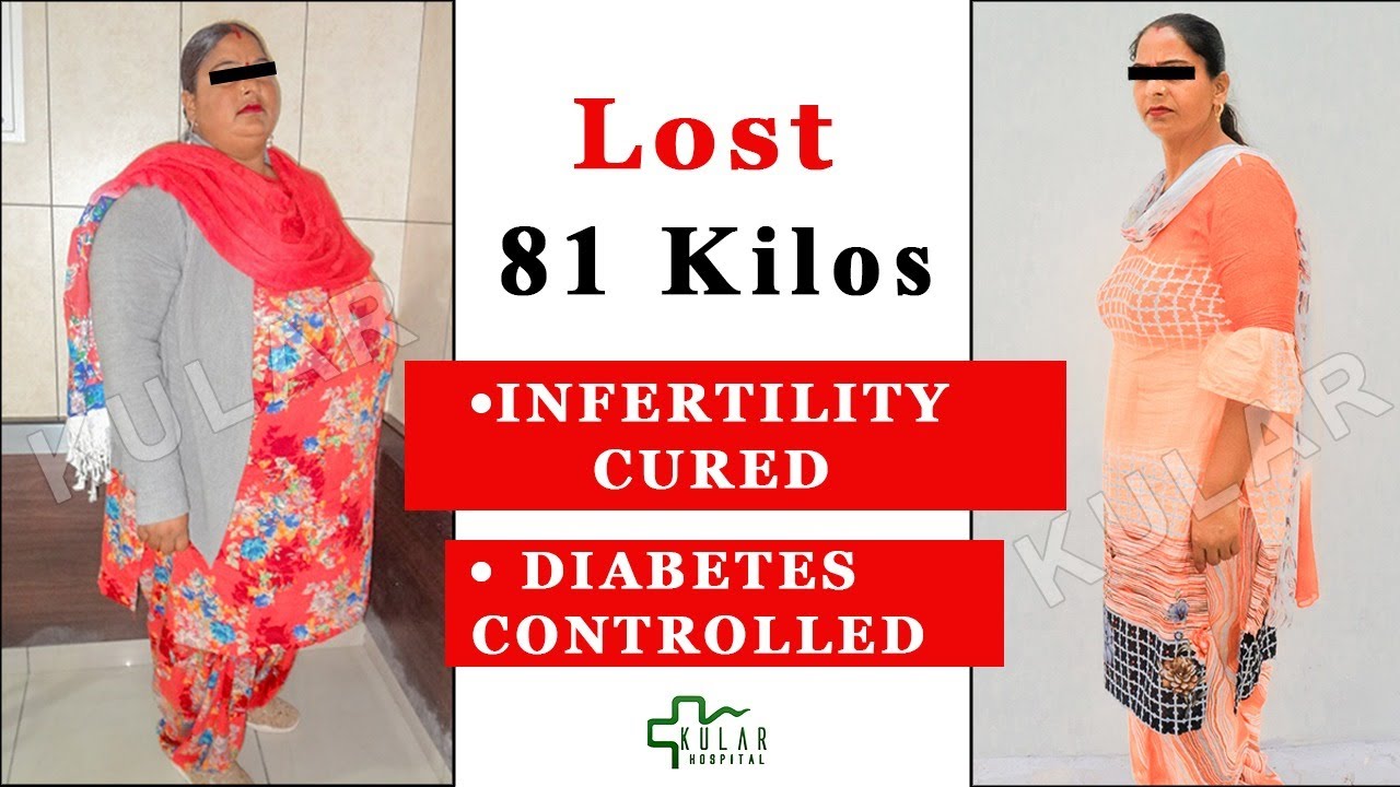 Lost 87 Kgs| Can you get Pregnant after Bariatric Surgery (Mini Gastric Bypass Surgery)?