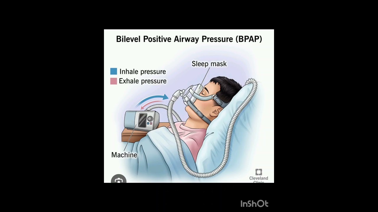 Bilevel#positive #airway #pressure #BPAP#respiration #lungs #support #medical#mbbs#