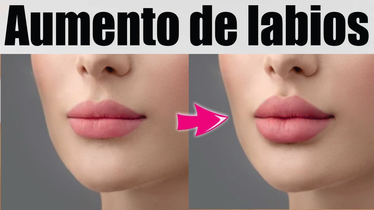 AUMENTO con ÁCIDO HIALURÓNICO 💋 BIOPLASTÍA de LABIOS 💄👄 ETERNA JUVENTUD ESTETIC CENTER