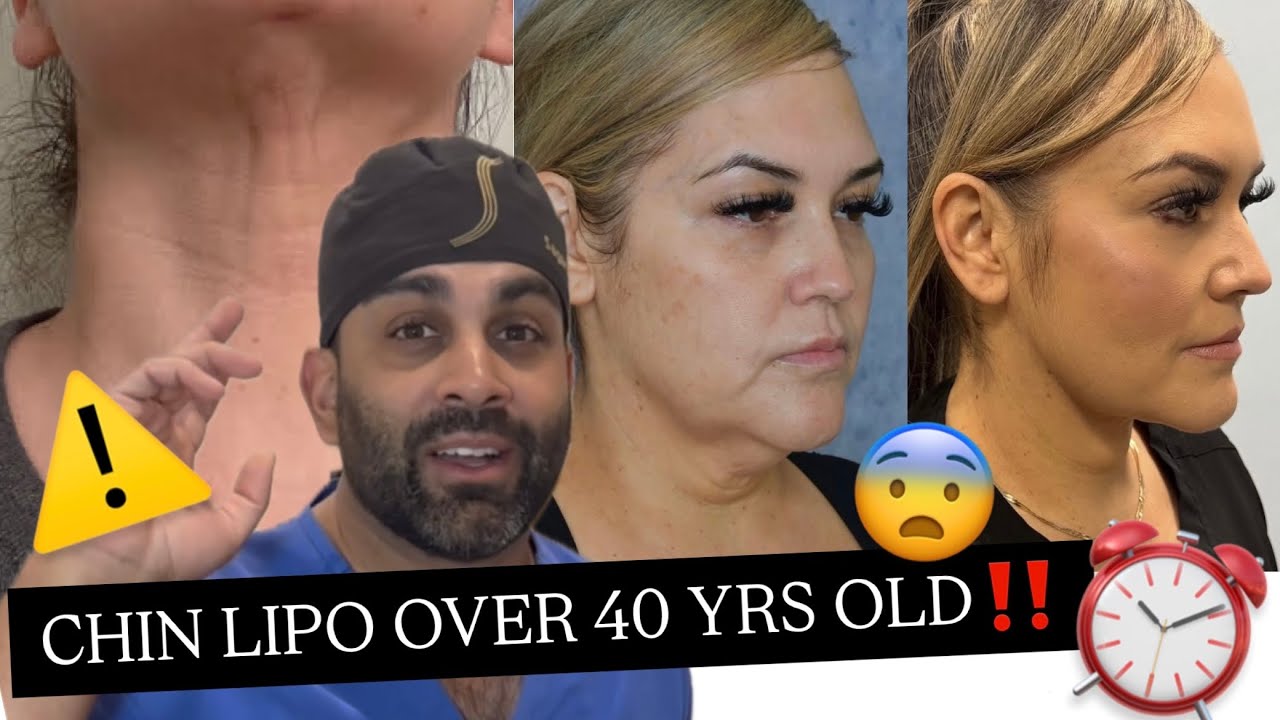 Chin Lipo Over 40 *the harsh truth no one tells you*