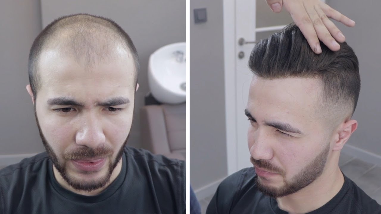 PROTEZ SAÇ - Hair Replacement