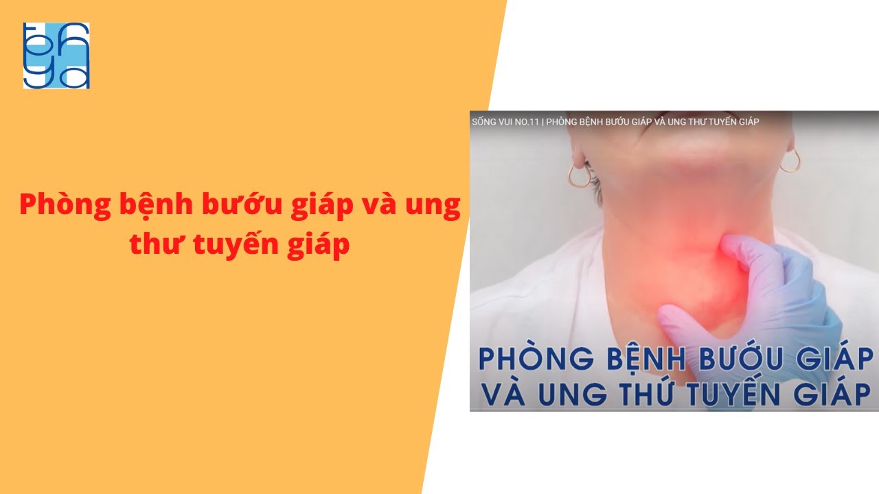 Phòng bệnh bướu giáp và ung thư tuyến giáp