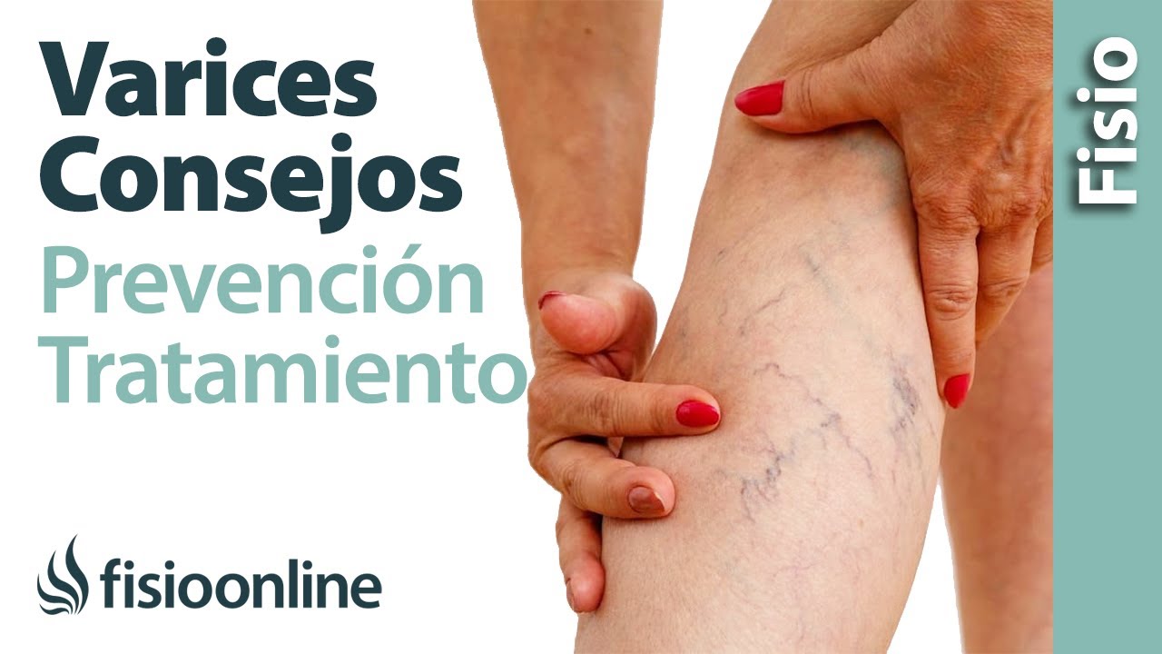 Mala circulación y varices - 10 consejos para su prevención y tratamiento