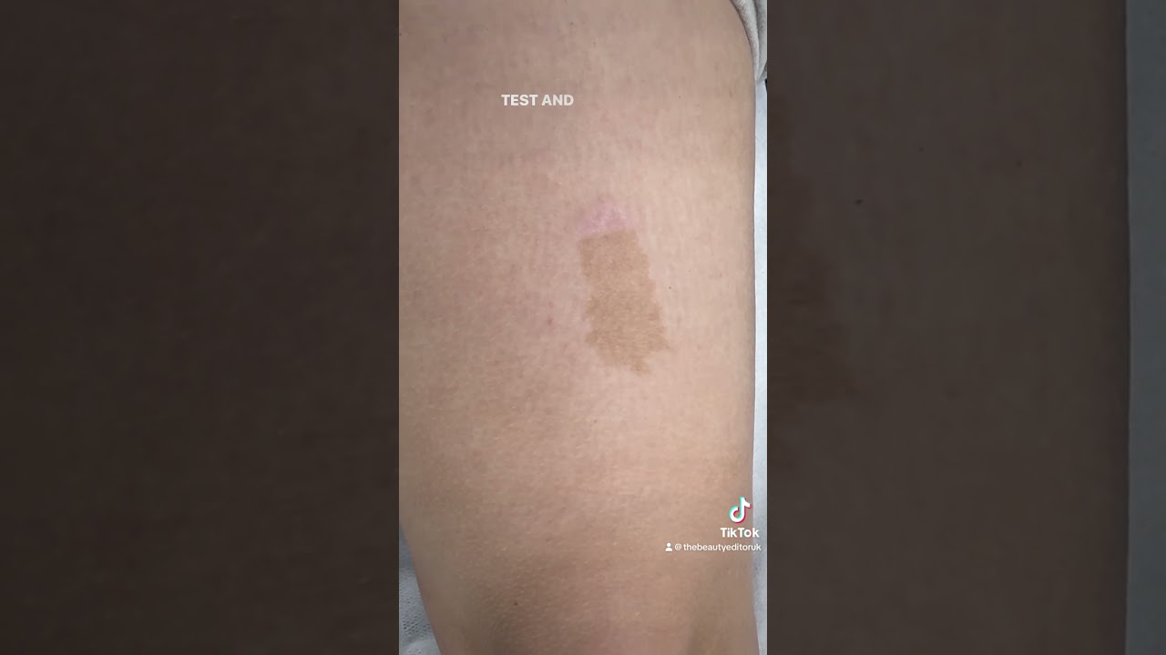 Cafe Au Lait Birthmark Removal #birthmarkremoval