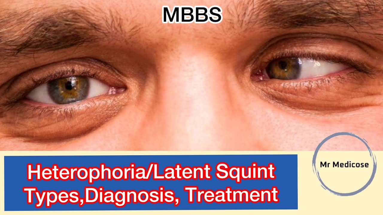 Heterophoria,Latent Squint,Types,Diagnosis,Treatme