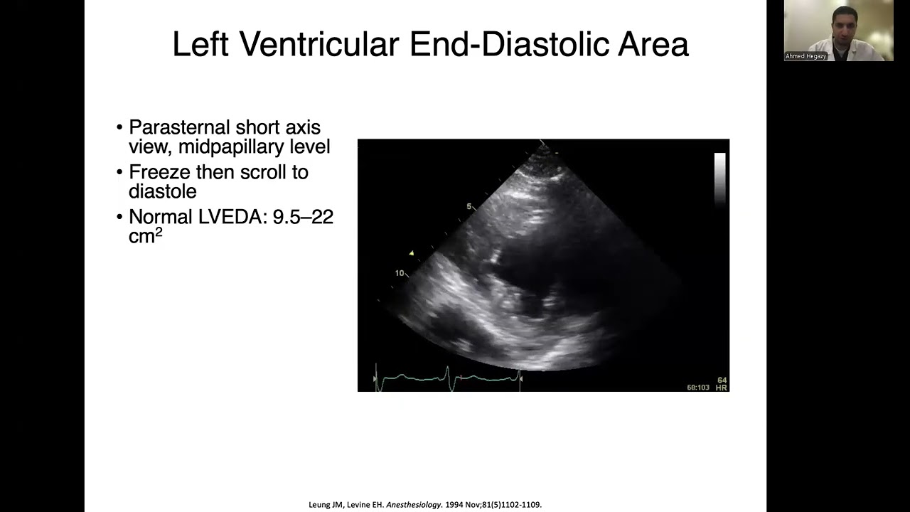Fluid Responsiveness, Fluid Tolerance, and VExUS.By :  Dr Ahmed Hegazy Critical Care Consultant