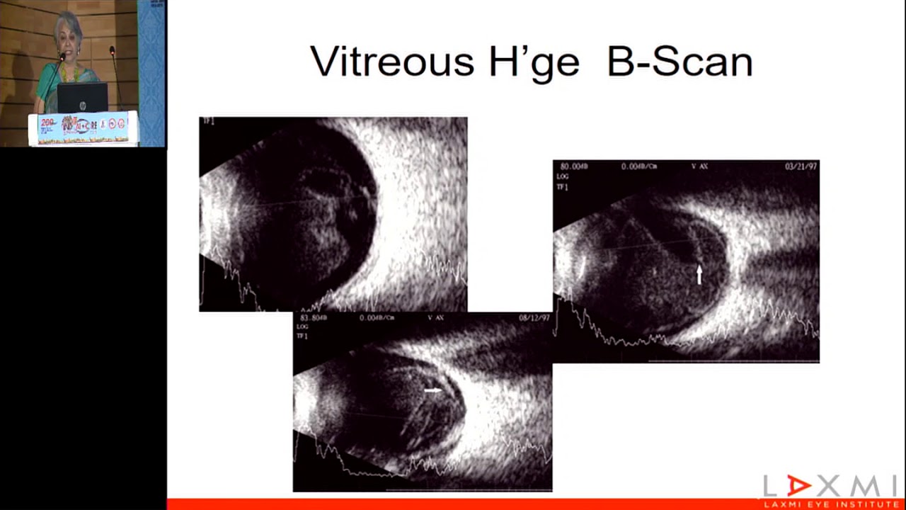 AIOC2019   IC489   Topic   Post Traumatic Glaucoma including Hyphaema   Dr mrs  Dhamankar R R