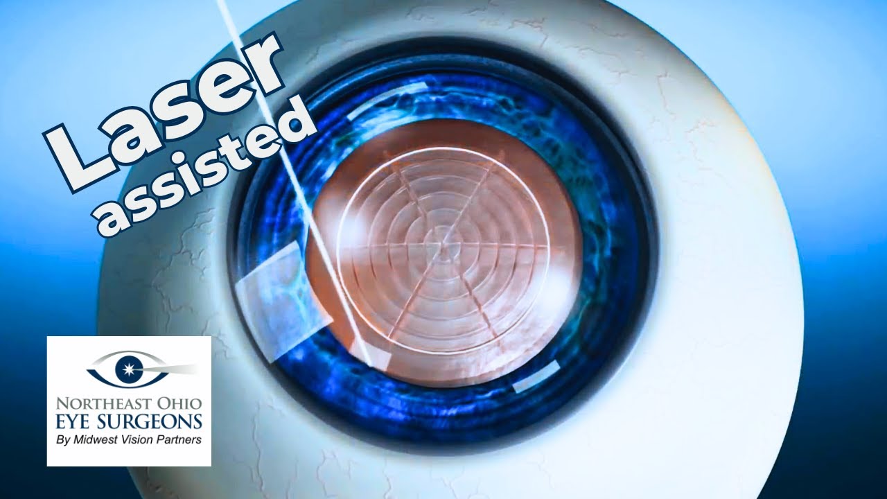 Discover the Advantages of Laser-Assisted Cataract Surgery at NEOES